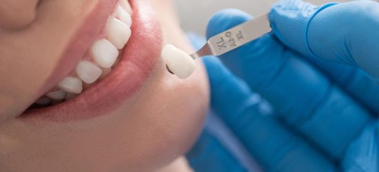 dental-veneers-02